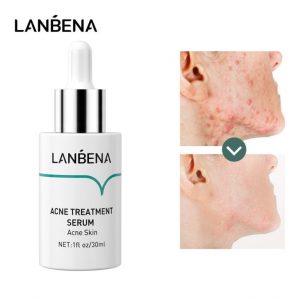 سرم ضدجوش و ضد آکنه لانبنا حجم 30 میلی لیتر Lanbena