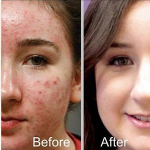 کوکتل ضد آکنه Anti Acne برند مزو لایک MESO LIKE