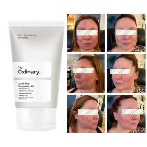 کرم ضد جوش آزلائین اسید برند اوردینری ORDINARY